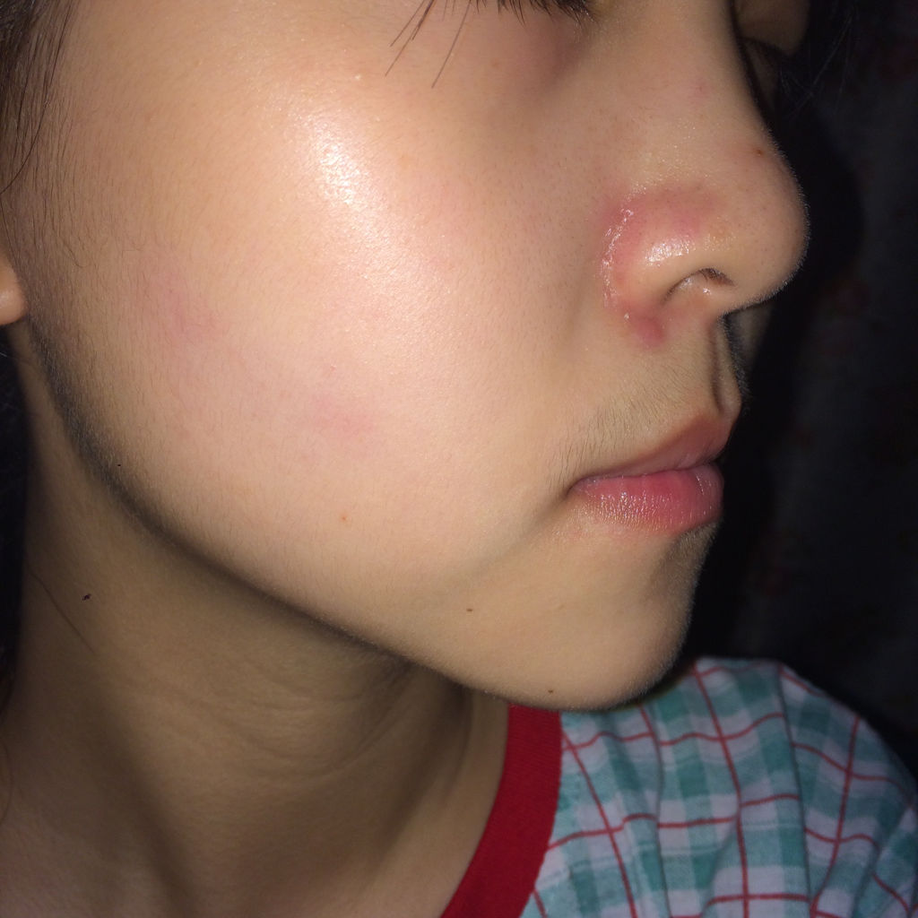 鼻翼两侧发红