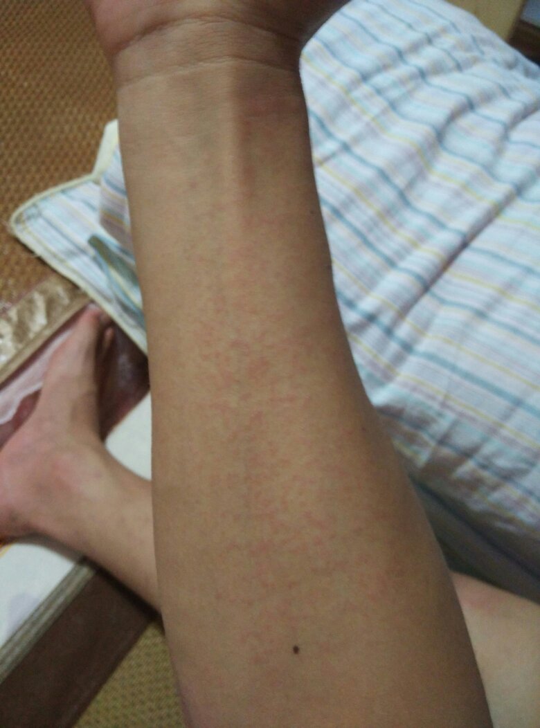 柴油洗手会过敏吗?