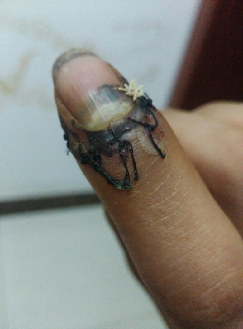 伤口缝合愈合后鼓起,按压剧烈疼痛