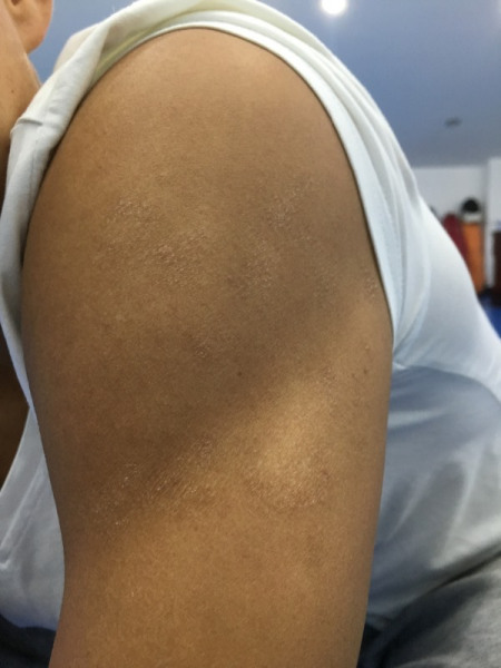 手臂有很多一小块一小块的干燥粗糙的白斑的东西不痒不痛就是颜色浅一
