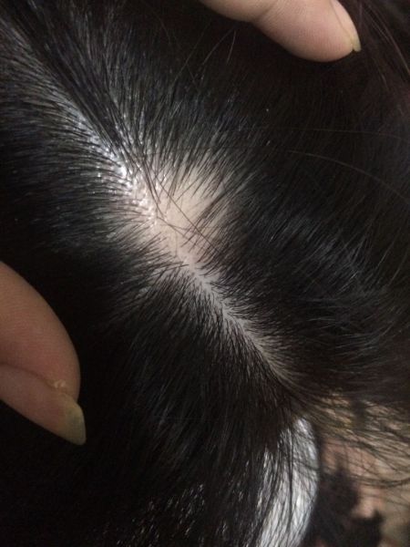 头皮发白怎么回事?