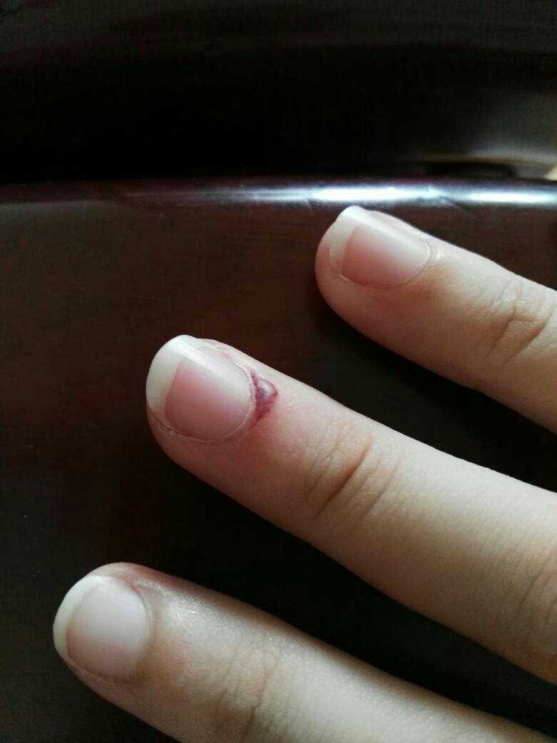 手被门夹到了怎么办?