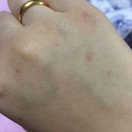 手和胳膊上起了一些透明的小水泡,刚起的时候不疼也不痒,也不红,后来