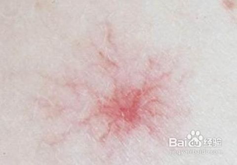 5  毛细血管组织感染后变形,毛细血管扩张.