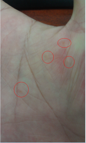 问:手上起透明小水泡