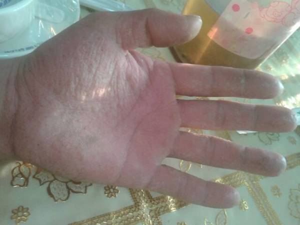 请问哪位医生知道鹅掌风的具体病症和治疗方